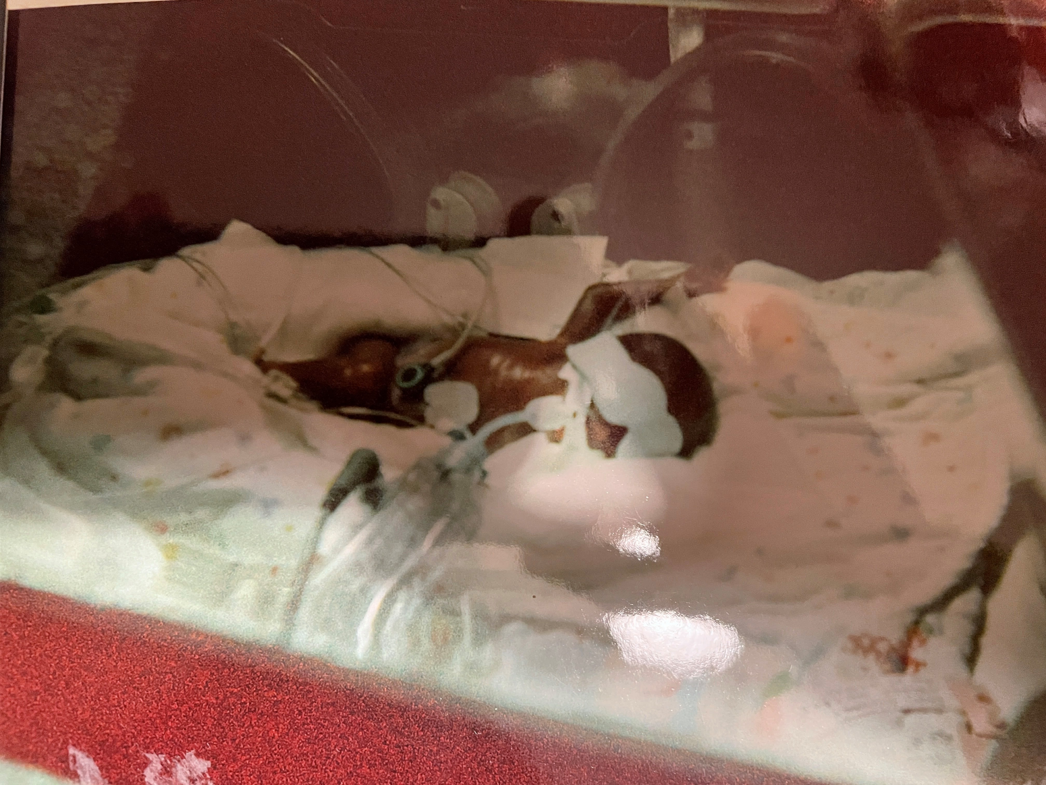Alisha, soon after her birth at 24 weeks. She is in an incubator, covered in tubes and incredibly tiny